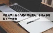 手指关节处有个凸起的硬包图片，手指关节处长了一个硬包